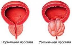 prostata norma